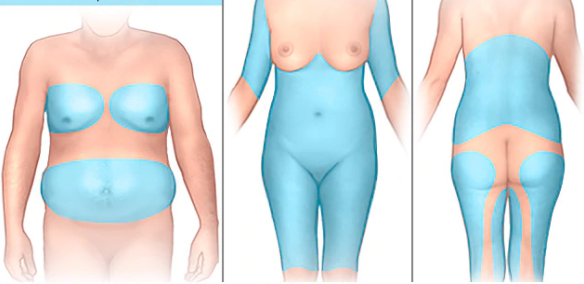 Liposuccion