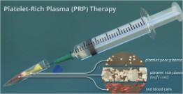 injection-prp-