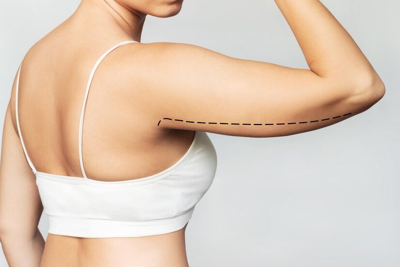 Comment se passe un lifting des bras ?